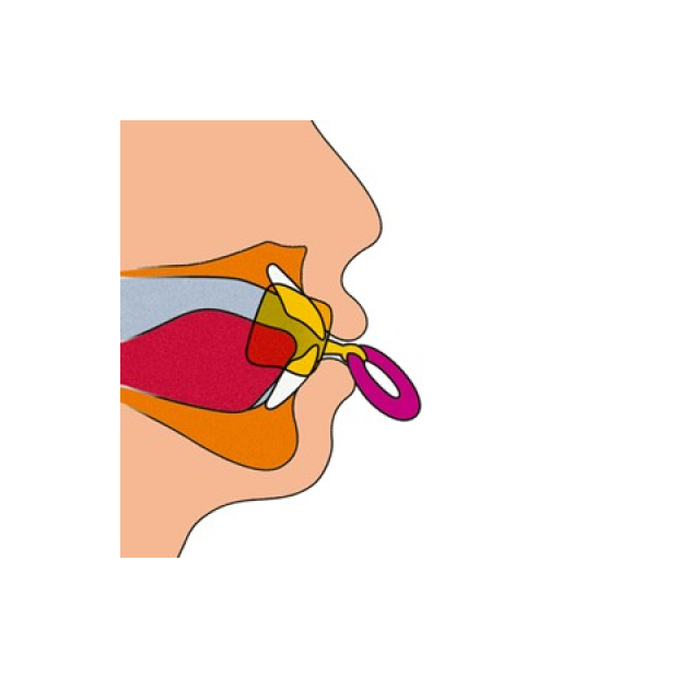 Oral vestibuleplade med tungeskærm